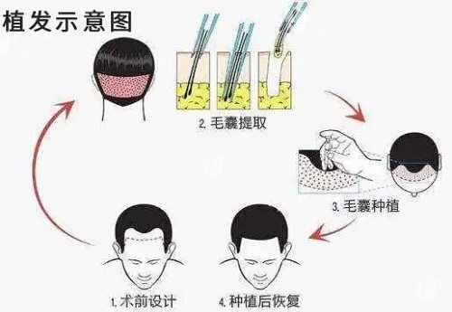 重庆唐森植发怎么样正规吗，是可靠植发机构技术优势详细讲解！
