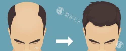 重庆唐森植发怎么样正规吗，是可靠植发机构技术优势详细讲解！