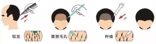 成都丝缘毛发医院正规吗，是正规植发机构服务技术很棒！