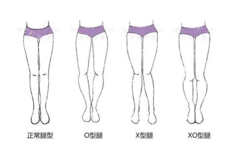 直腿塑形和腿部吸脂一样吗？不一样！从原理、适应症、优缺点等对比下