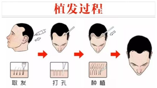 重庆唐森植发怎么样正规吗，是可靠植发机构技术优势详细讲解！