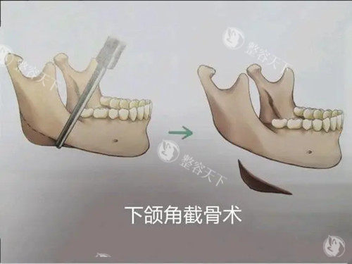 下颌角截骨术卡通示意图 下颌角截骨术卡通示意图