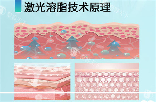 医美冷知识：超塑溶脂术后结果分阶段观察指南，为什么有人7天起效有人需等28天？