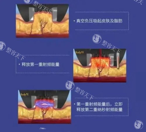 超塑溶脂双效叠加技术揭秘：射频+冷冻分层溶脂如何精密击破脂肪细胞？