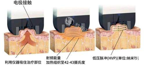 超塑溶脂双效叠加技术揭秘：射频+冷冻分层溶脂如何精密击破脂肪细胞？