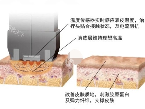 超塑溶脂双效叠加技术揭秘：射频+冷冻分层溶脂如何精密击破脂肪细胞？