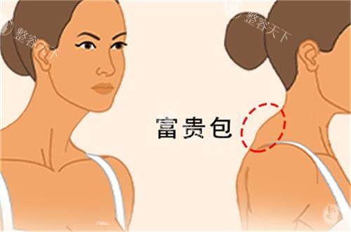 长沙艺脂医疗美容医院吸脂富贵包结果怎么样？不仅技术好且性价比较高！