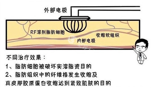 超塑溶脂禁忌症必读：孕期/凝血障碍/脂肪过薄人群为何被禁止操作？