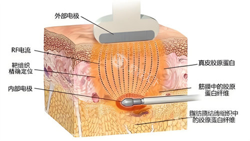 医美冷知识：超塑溶脂术后结果分阶段观察指南，为什么有人7天起效有人需等28天？