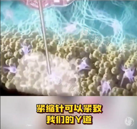 紧缩针怎么样 紧缩针怎么样