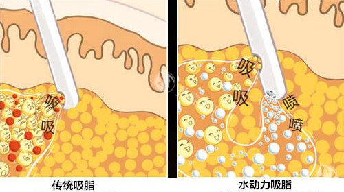 全身抽脂风险等级划分：凹凸不平/皮肤坏死高发群体BMI值与皮下脂肪厚度阈值！