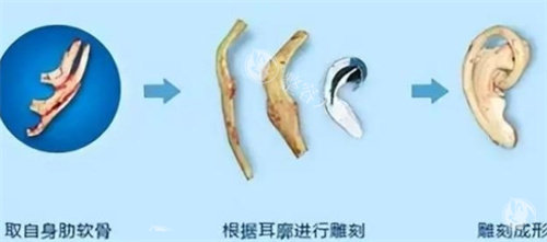 耳再造肋软骨雕刻成型的过程 耳再造肋软骨雕刻成型的过程
