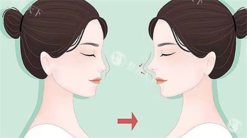 广州高顺福做鼻子怎么样?做鼻子整手术和鼻修复手术很出名,高顺福鼻整形价格并不贵!