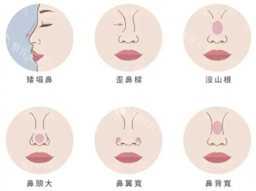广州高顺福做鼻子怎么样?做鼻子整手术和鼻修复手术很出名,高顺福鼻整形价格并不贵!