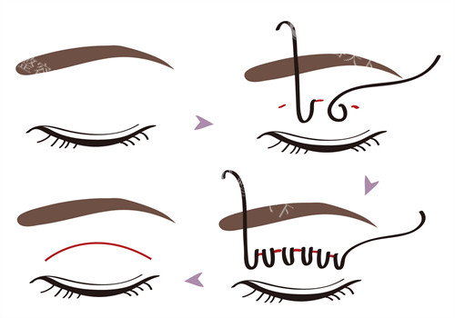 朱冠峰医生如何预约？深圳维瑞整形坐诊！面诊方式+眼整形技术+医师口碑这里分享！