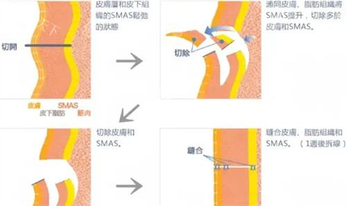 王志军做拉皮手术怎么样？高位SMAS除皱术|负张力缝合|手术成效好