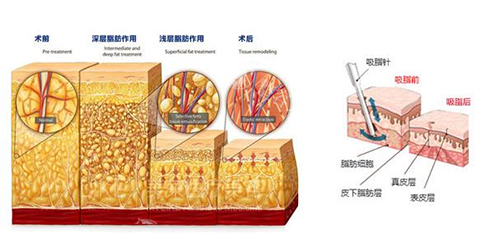 西安王仁根医生吸脂怎么样？吸脂技术好 用户口碑和评价也非常好！