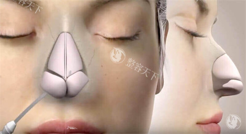 彭鑫隆鼻技术怎么样?实例告诉你他用的技术，前后对比与审美、收费标准！
