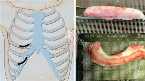 千万不要做肋软骨隆鼻是真的吗？肋软骨隆鼻到底好不好？会对身体有害吗