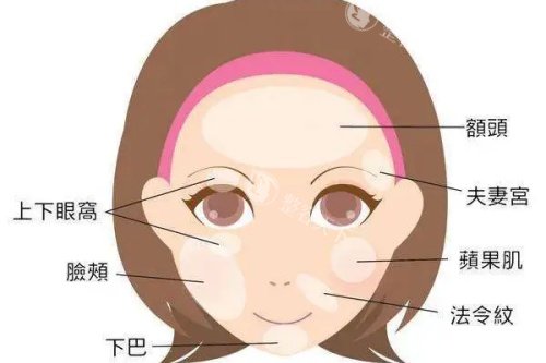 面部可以脂肪填充的部位卡通图 面部可以脂肪填充的部位卡通图