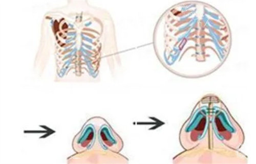 千万不要做肋软骨隆鼻是真的吗？肋软骨隆鼻到底好不好？会对身体有害吗