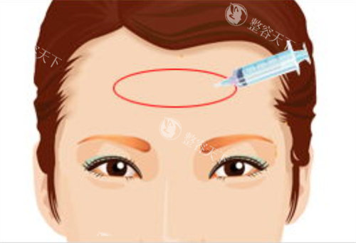 填充额头术玻尿酸注射动画图 填充额头术玻尿酸注射动画图