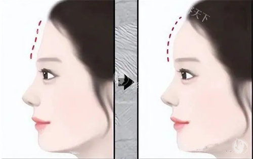 假体填充额头手术前后对比动画图