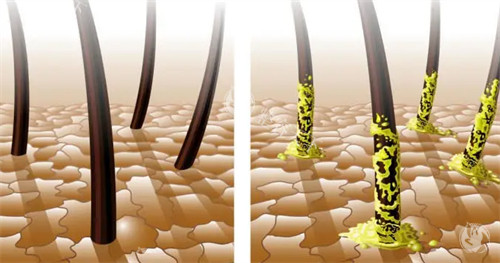 健康毛囊与脂溢性毛囊的区别对比图