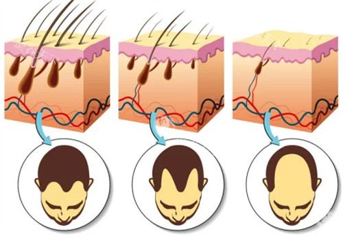 不同程度脱发的对比图解