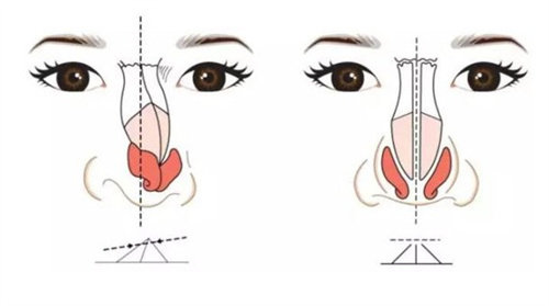 三次隆鼻修复经历：山根从低到高的材料迭代史！