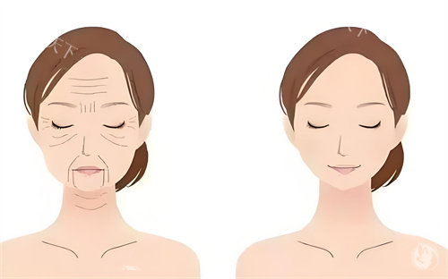 下眼睑紧致提升术1万起价贵吗?与切眼袋有三大本质区别!2025年结果保持年限全解析