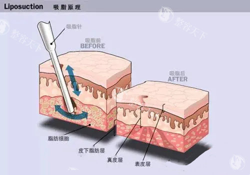 水动力吸脂VS负压吸脂哪个好？3大对比解析帮你选对瘦身方案！