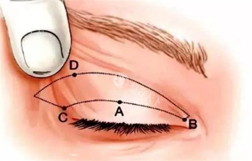 北京联合丽格医疗美容医院做双眼皮医生推荐！爆款实例解析：平行款VS开扇款怎么选