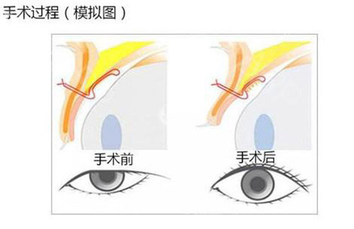 眼提肌手术照片