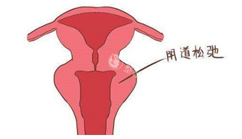 阴道松弛动画演示图 阴道松弛动画演示图