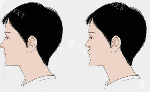鼻基底填充选自体脂肪还是假体？从材料材料特性、真实实例到避坑指南帮你选