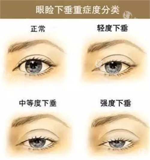 眼睑下垂程度 眼睑下垂程度