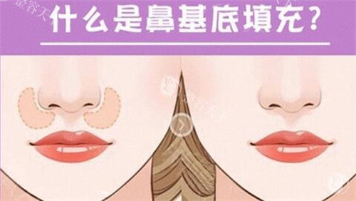 鼻基底填充选自体脂肪还是假体？从材料材料特性、真实实例到避坑指南帮你选