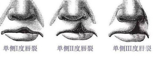 做唇腭裂二期修复鼻子和嘴巴能一起做吗?不能!同期手术修复部位/手术难度/风险深度预警!