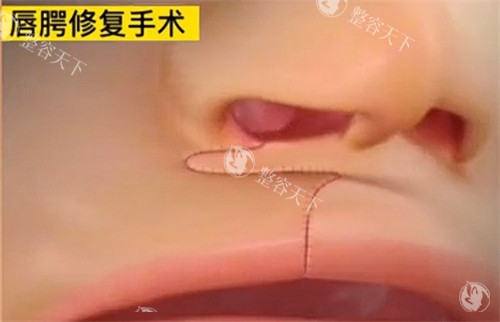 做唇腭裂二期修复鼻子和嘴巴能一起做吗?不能!同期手术修复部位/手术难度/风险深度预警!