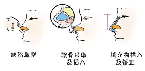 谢洋春鼻综合做的怎么样？经验比较丰富|技术娴熟|口碑好