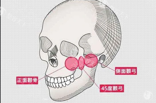 颧骨颧弓大概位置示意图 颧骨颧弓大概位置示意图
