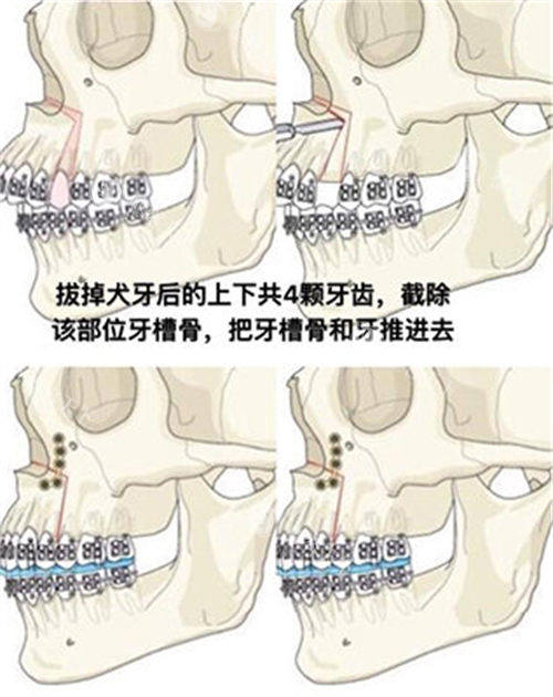 双鄂手术方式演示动画图 双鄂手术方式演示动画图