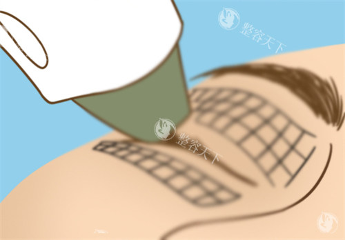禤丽艮医生是广州地区的热玛吉认证医师，在中家医家庭医生医疗美容任职!