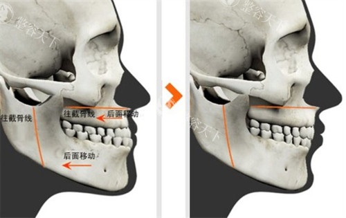 双鄂手术对比图 双鄂手术对比图