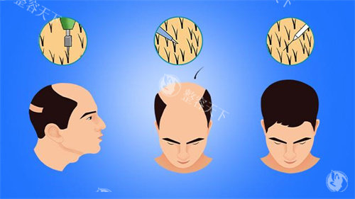 男性毛发移植对比动画图 男性毛发移植对比动画图
