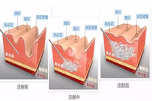 玻尿酸注射皮肤内在过程示意图 玻尿酸注射皮肤内在过程示意图