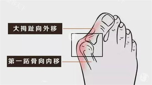 大脚骨的症状 大脚骨的症状
