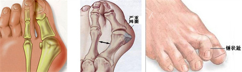 大脚骨的表现 大脚骨的表现