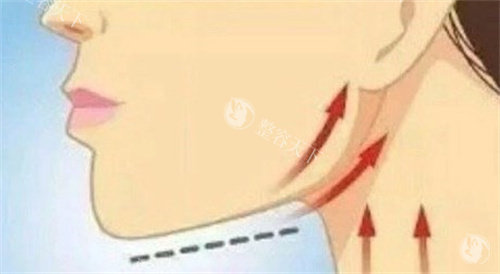 沈阳杏林埋线提升做面部提升结果如何？听说不仅技术好.性价比也不错